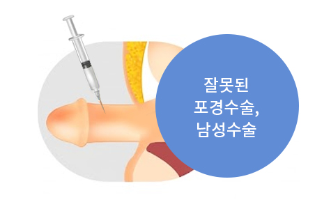 포경/남성수술 부작용
