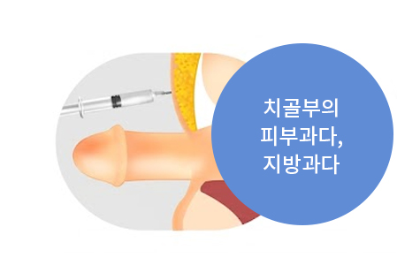 치골부 피부 및 지방과다