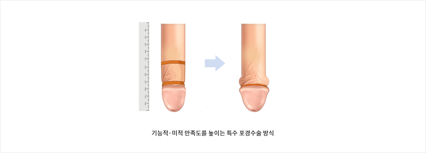 디자인 방식 + 슬리브 방식 포경수술