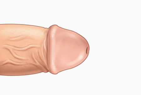 귀두 확대수술