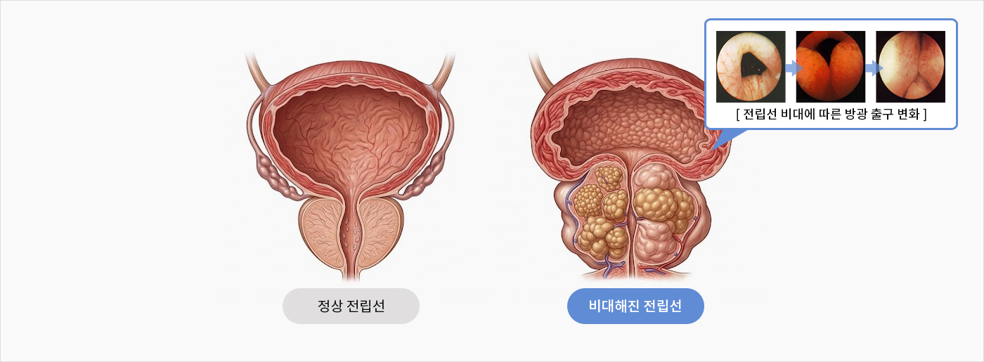 연령별 전립선비대증 유병률
