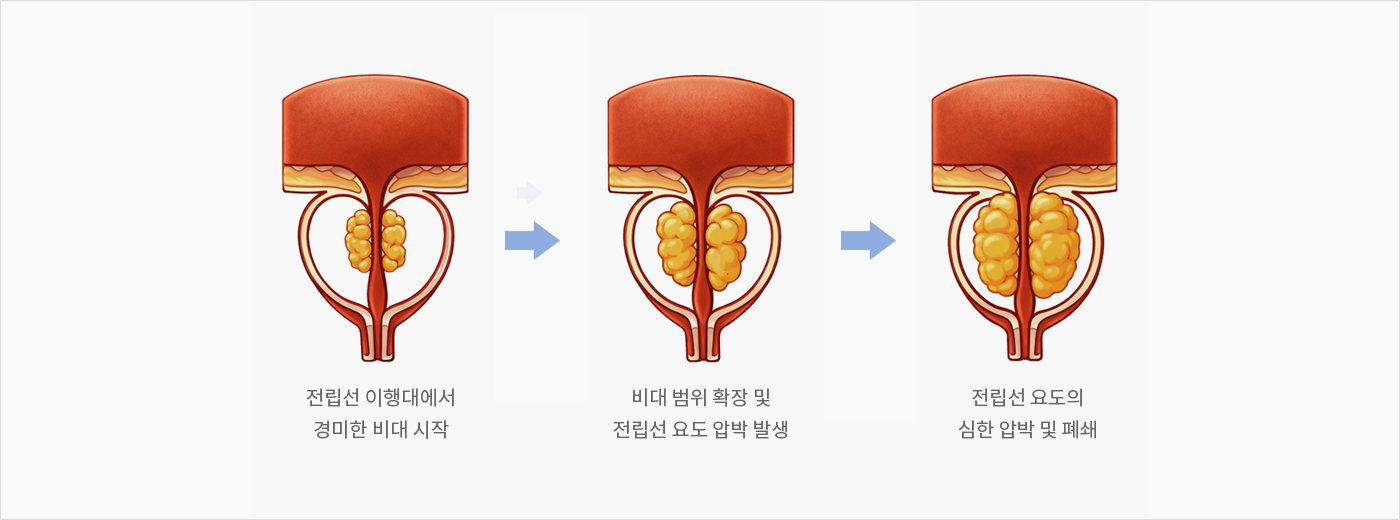 전립선비대증 진행에 따른 합병증