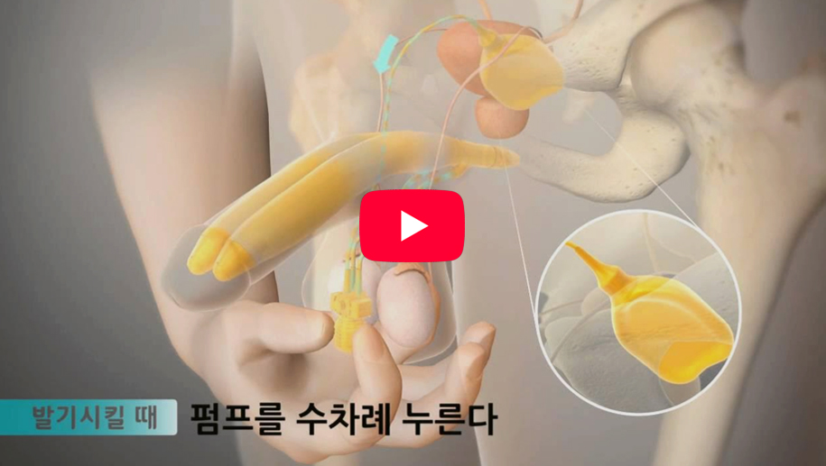 세조각 팽창형 보형물 영상 보기